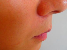 鼻下ひげ脱毛後