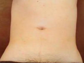 下腹部脱毛後