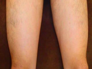 ひざ上脱毛後