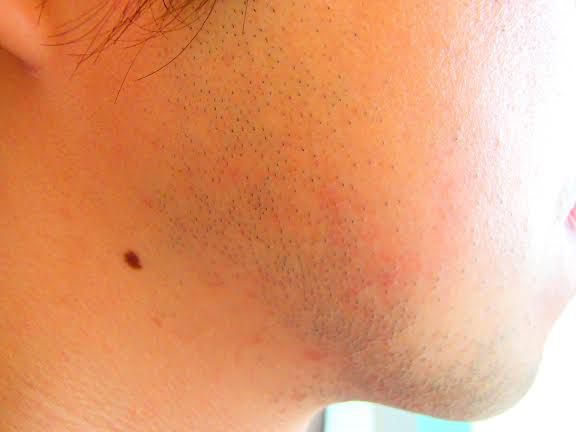 ほほひげ脱毛前