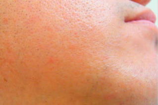 口下ひげ脱毛後