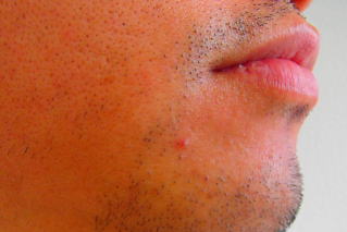 口下ひげ脱毛前