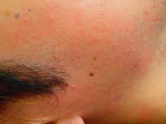 もみあげ脱毛前