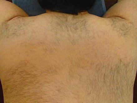 背中上脱毛前