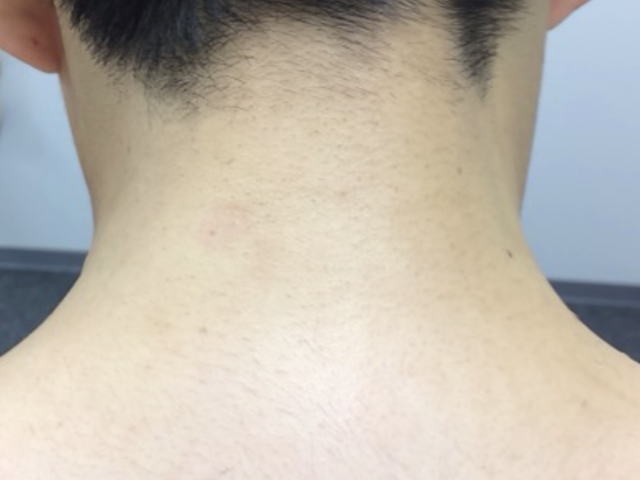 うなじ脱毛後