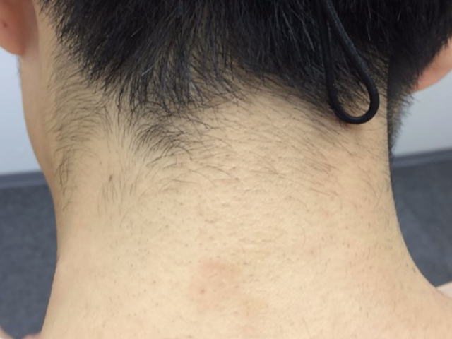 うなじ脱毛前